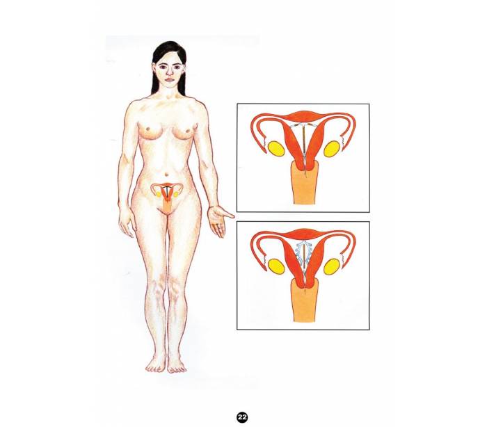 Aile Planlaması Danışmanlığı İçin Resimli Rehber